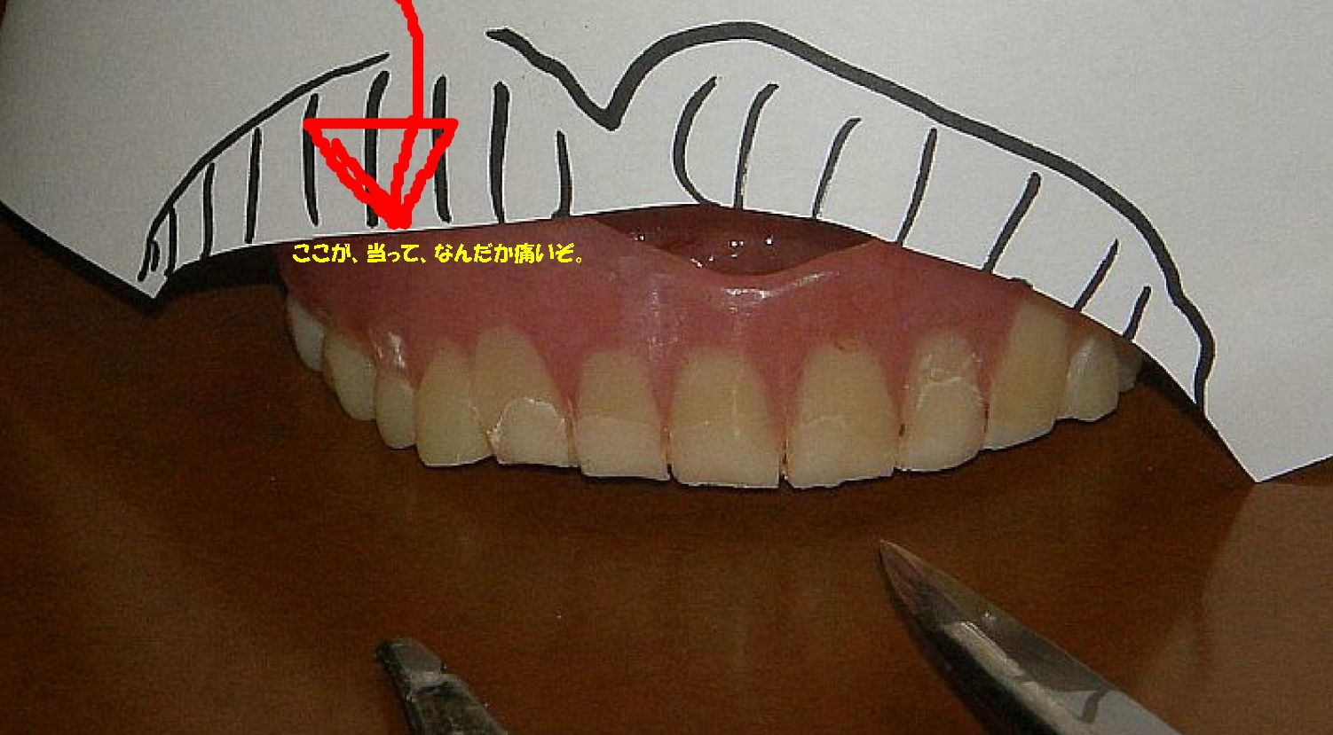 仮歯とはこんなものか。