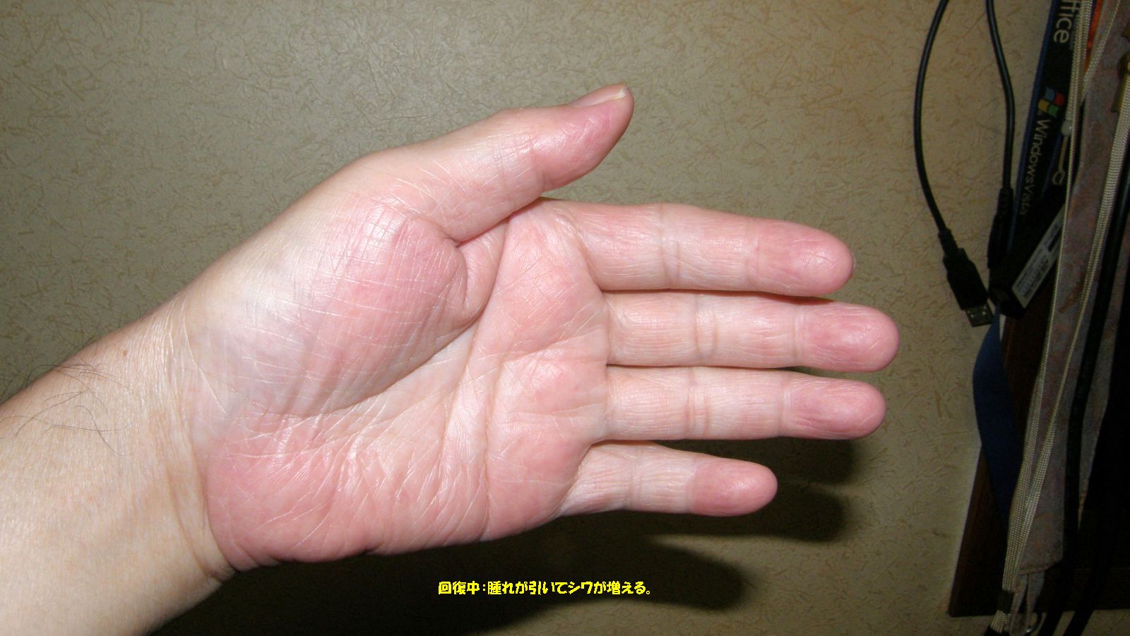 腫れが引いてしぼんできた